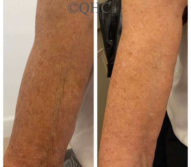profhilo-treatment-before-and-after-4