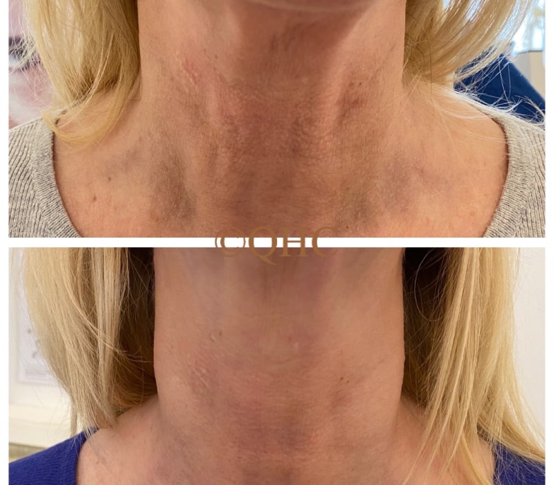 profhilo-treatment-before-and-after-6